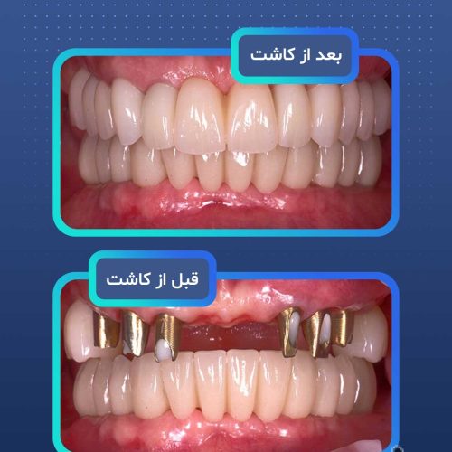 ایمپلنت دندان در مشهد  با اقساط بلندمدت و شرایط ویژه