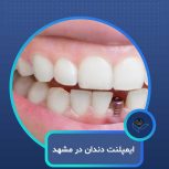 ایمپلنت دندان در مشهد  با اقساط بلندمدت و شرایط ویژه