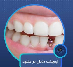 ایمپلنت دندان در مشهد  با اقساط بلندمدت و شرایط ویژه
