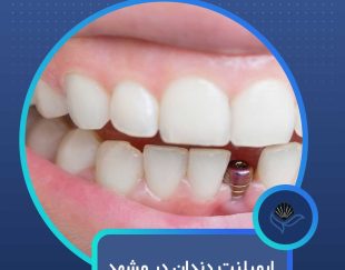 ایمپلنت دندان در مشهد  با اقساط بلندمدت و شرایط ویژه